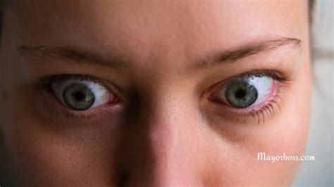 Thyroid Eye Disease: What You Need to Know