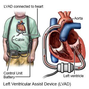 Lvad (Left Ventricular Assist Device) - What You Need to Know