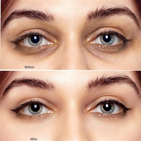 Premium Photo | Woman's eyes before and after procedures Skin problems ...