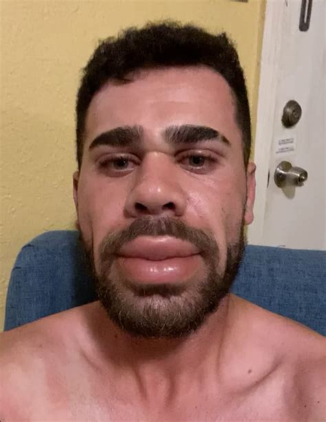 Photos Showing How Bad an Allergic Reaction Can Be | eBaum's World