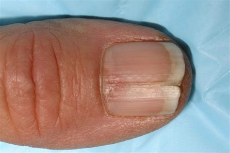 Lunula of Nails: What It Says About Your Health? – NailDesignCode