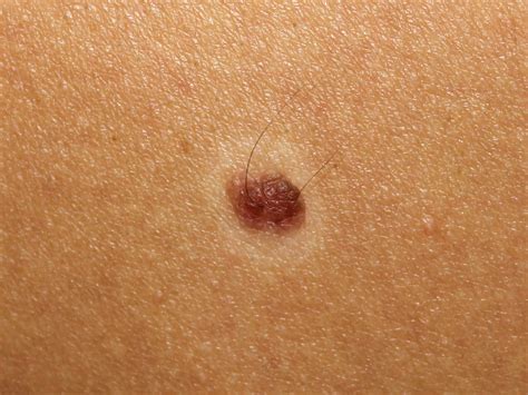 Halo Nevus: Understanding Causes, Diagnosis & Treatment