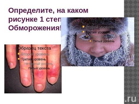Презентация "Обморожение" - скачать презентации по ОБЖ