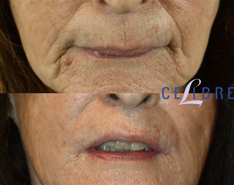 Radiesse Before and After Pictures