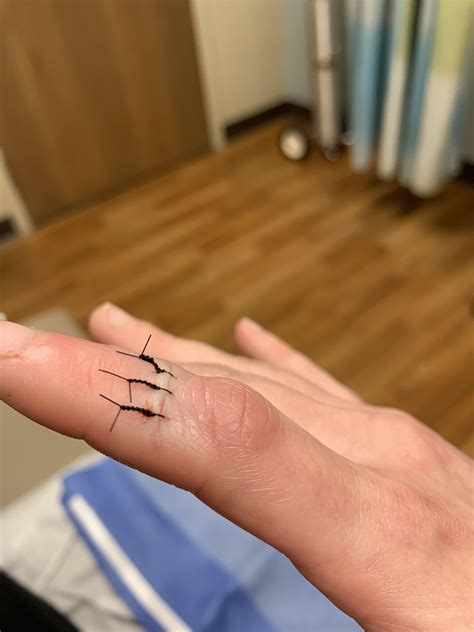how to know if you need stitches in your finger