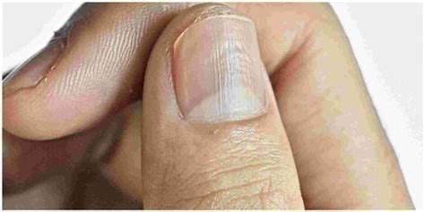 understanding  real   vertical ridges   nails dr