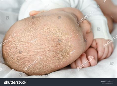 Crust Skin