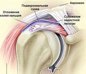 Лечение тендиитов в Запорожье с помощью артроскопии.