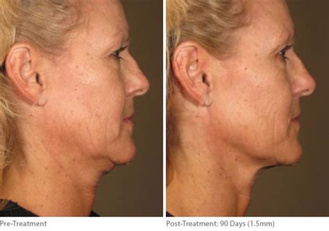 Ulthera Lift Photos | Houston, Tx | Patient 8166