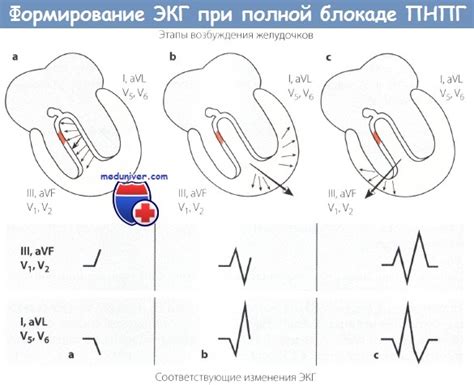 Признаки полной блокады правой ножки пучка Гиса (ПНПГ) на ЭКГ