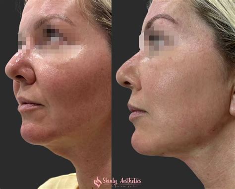 thread face lift before and after 5