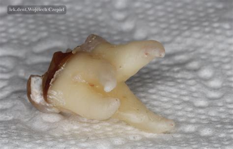 Chirurgia stomatologiczna | NZOS MEDI-DENT
