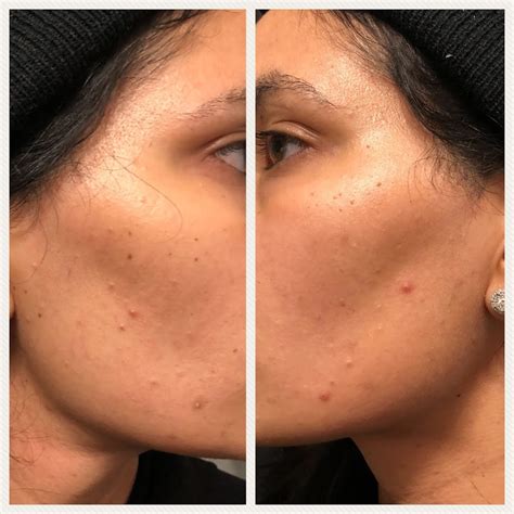 facial ruin  face steffanys choice