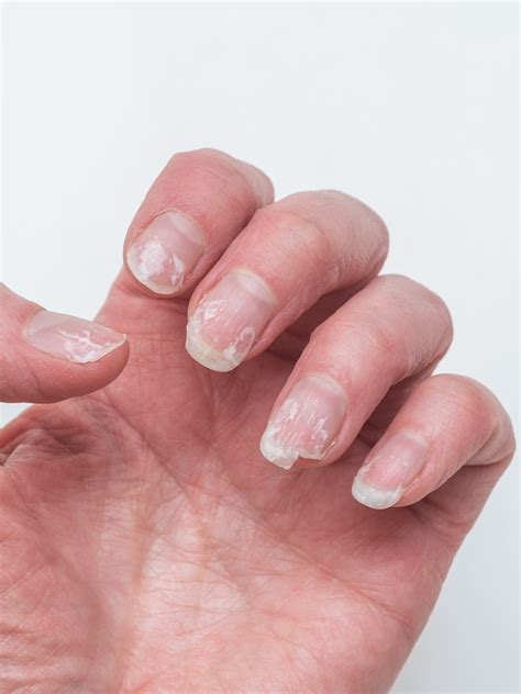 Unhas Que Descamam O Que Fazer - Por que minhas unhas quebram e descamam: 8 passos para fortalecer de vez