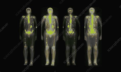 nuclear medicine bone scan stock image  science photo