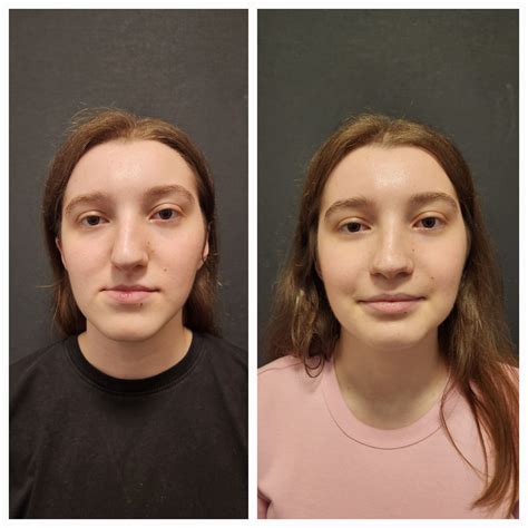 What You Need to Know About Double Jaw Surgery Before and After – Prof