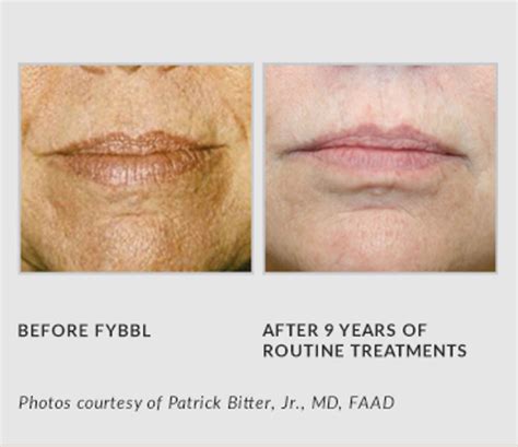 Sciton BBL Treatment - Central Dermatology Clinic