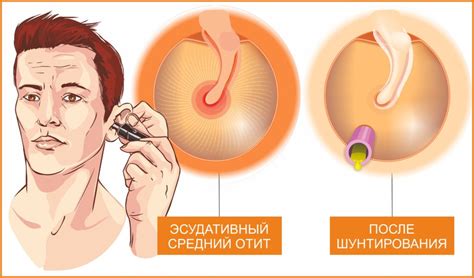 Шунтирование барабанной полости - операция, цена в Новой Мировой Хирургии