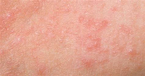 What is scabies? Everything you need to know about scabies rash.