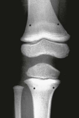 Metabolic Bone Disease | Radiology Key