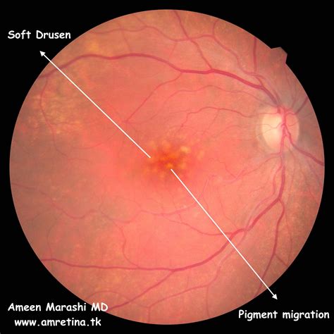 drusen   neovascular armd  subtypes