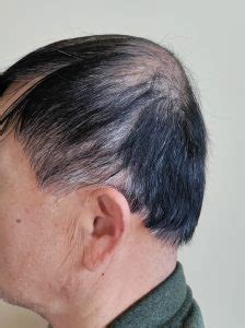 older asianj male with brachycephaly side vew Dr Barry Eppley - Explore ...