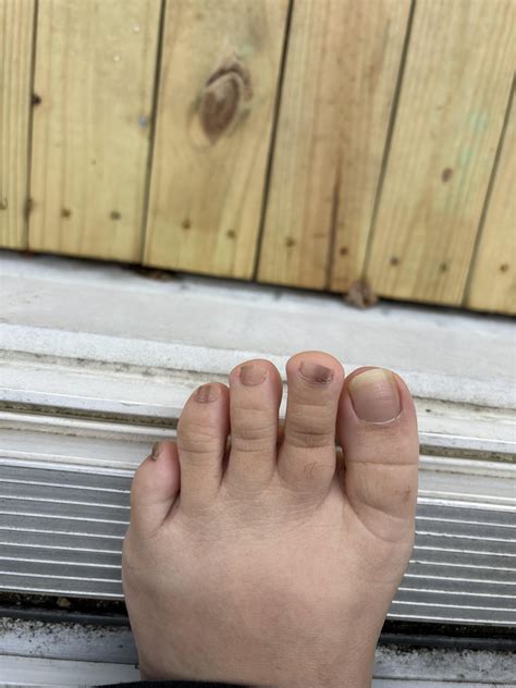 Brown lines in toenails : r/DermatologyQuestions