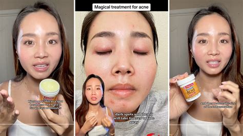 Celebrities Acne Treatment