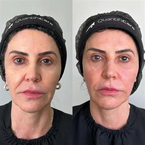 Coolfase Antes E Depois - Coolfase: O Que é? Como Funciona? Veja Fotos de Antes e Depois!