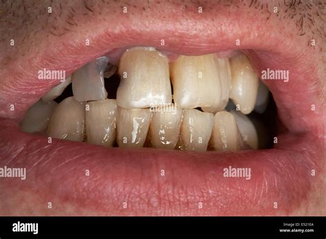 how to know if your tooth is rotting