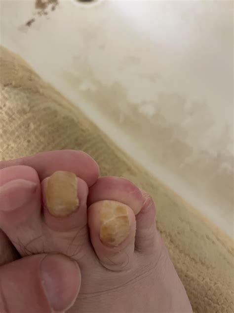 Toenail Fungus/Weird Toenail : r/medical_advice