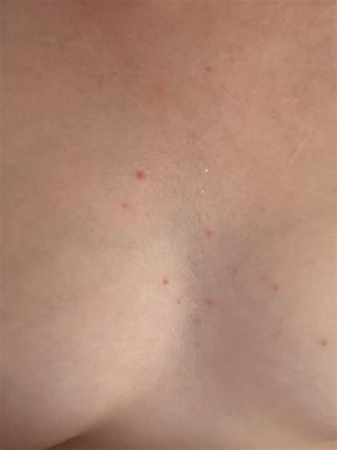 Red spots on chest : r/Skincare_Addiction