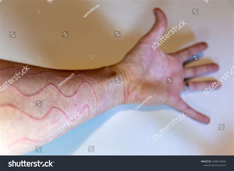 Dermatographic Urticaria Known Dermographism Dermatographism Skin Stock ...