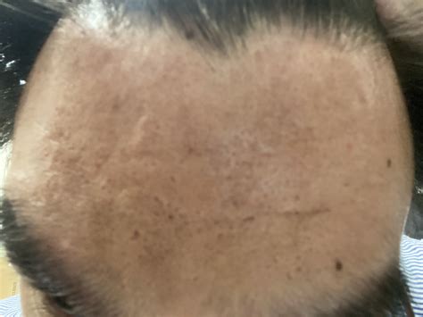 Are these dark spots on my forehead? : SkincareAddicts