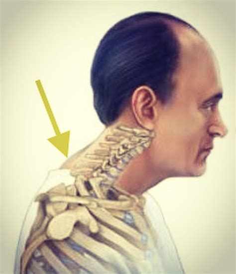 Understanding Neck Hump Causes: Dowager's Hump and Poor Posture ...