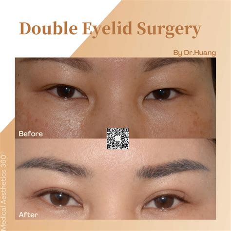 Asian Eyelid Surgery Sydney | Double Eyelid Surgery Sydney: Medical ...