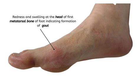 Gout- 8 Things You Need To Know To Prevent And Treat It