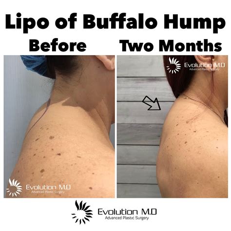 buffalo hump moon face cushing syndrome before and after 8