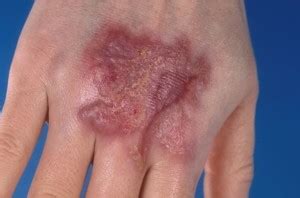 Pyoderma Gangrenosum | Medical Point