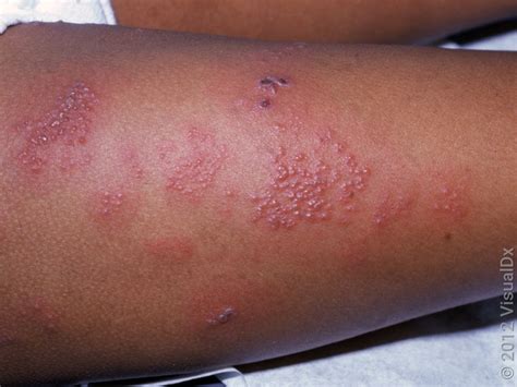 What Does a Shingles Rash Look Like? Stages in Pictures - GoodRx