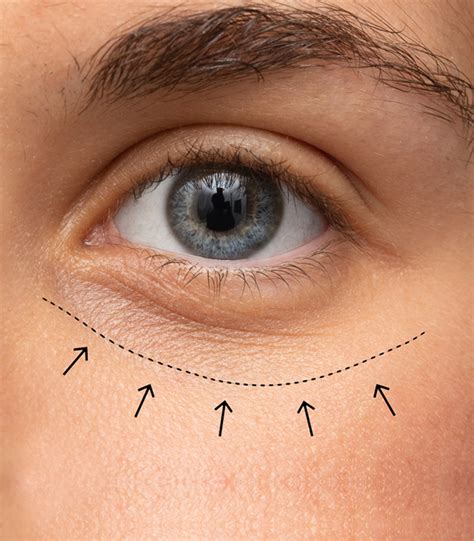 cosmetic eyelid surgery    jones eye clinic