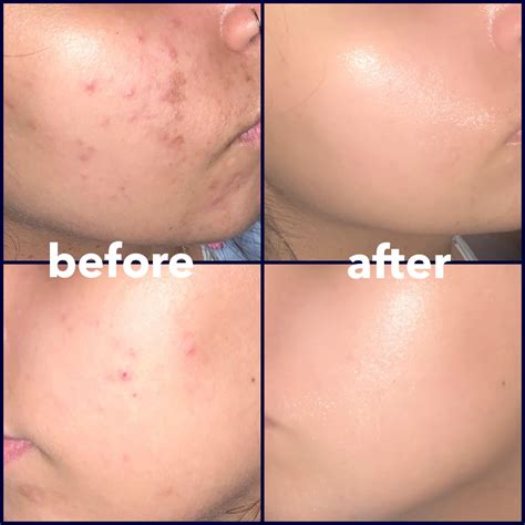 how to apply tretinoin 7