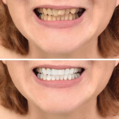 Teeth Whitening Before And After | Parkway Dental Care