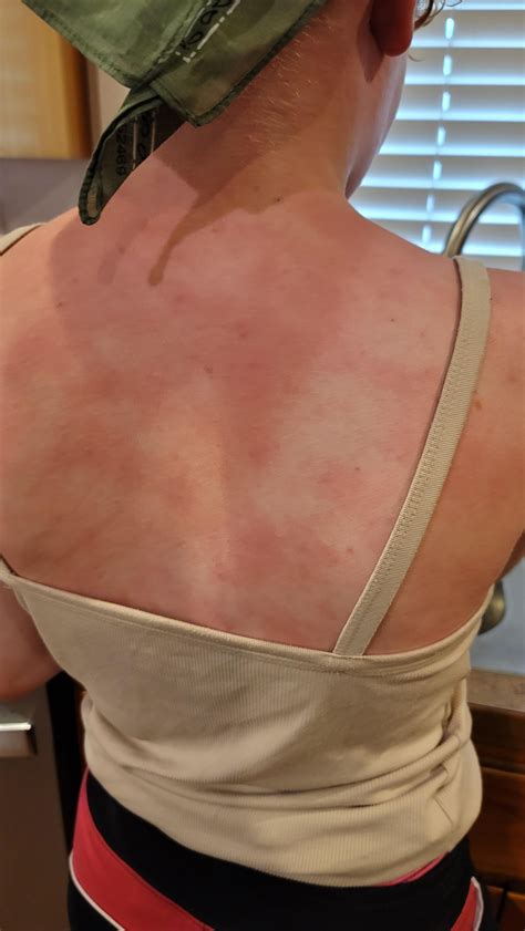 Daughter's skin is reacting to water and sweating and it seems to get
