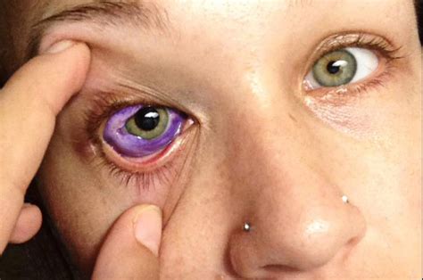 pic eye disease  hannah rowlandson blog