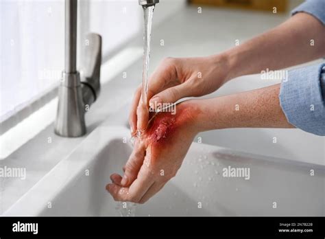 Woman holding hand with burn under flowing water indoors, closeup Stock ...