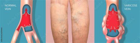 Varicose veins on a female senior legs. The structure of normal and ...