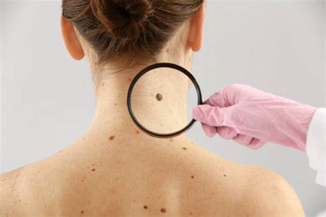 What Are The Symptoms Of Skin Cancer?