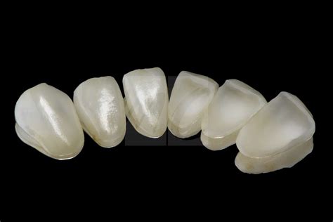 Frontzahn Veneers OK 04 - Dentale Bilder | m.c. Zahntechnik Oldenburg ...