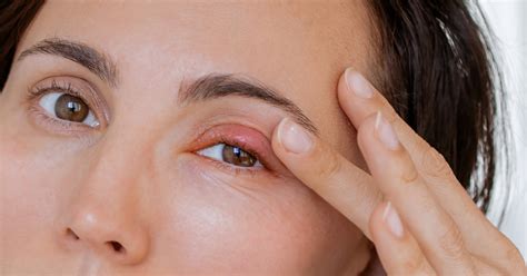 Can You Pop a Stye? | 1-800 Contacts